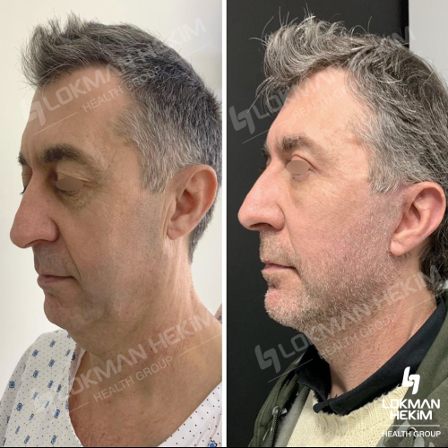 Thread lift Before / After photo